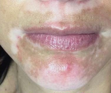 Vitiligo patches around the mouth